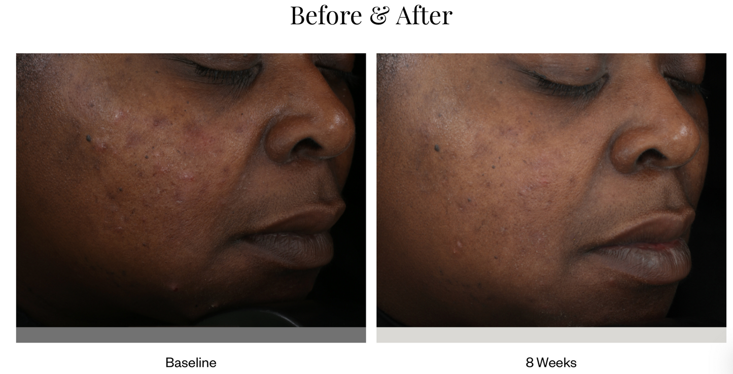 Acne Clarifying Treatment