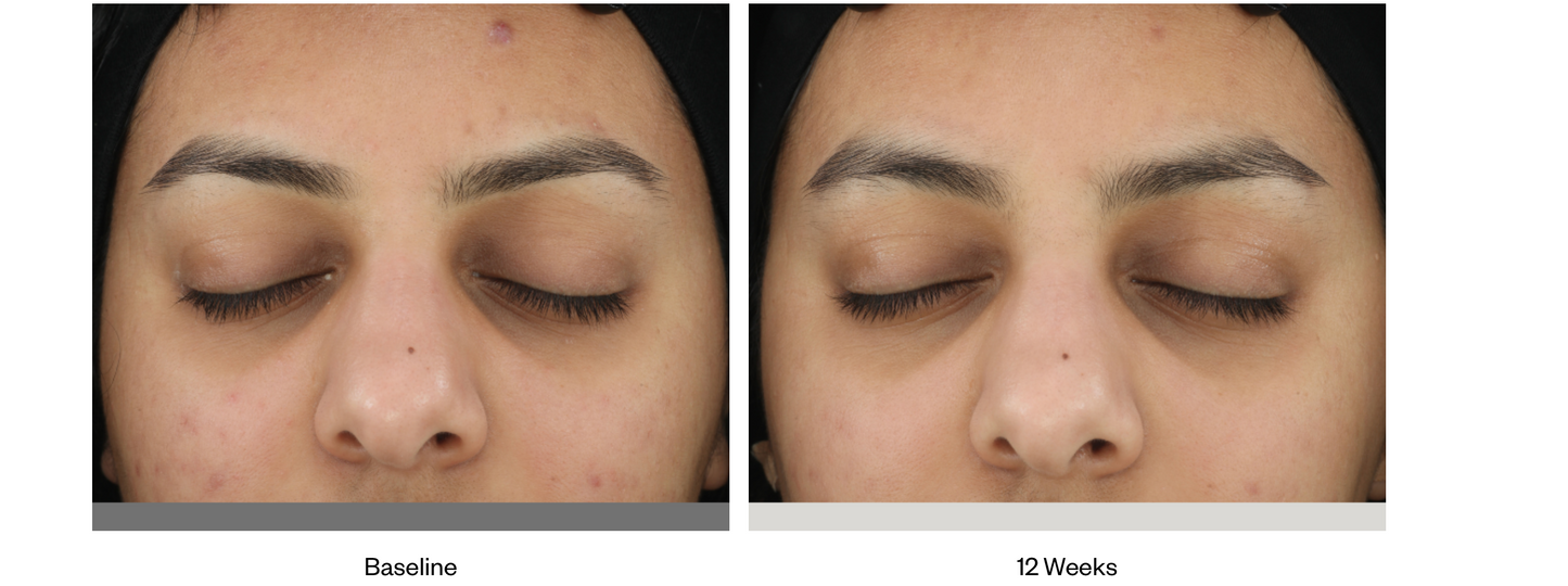Acne Clarifying Treatment