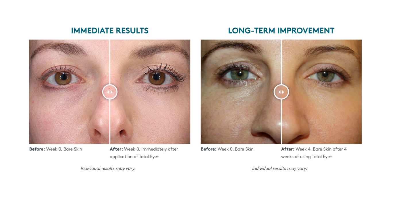 Total Eye® 3-in-1 Renewal Therapy SPF 35