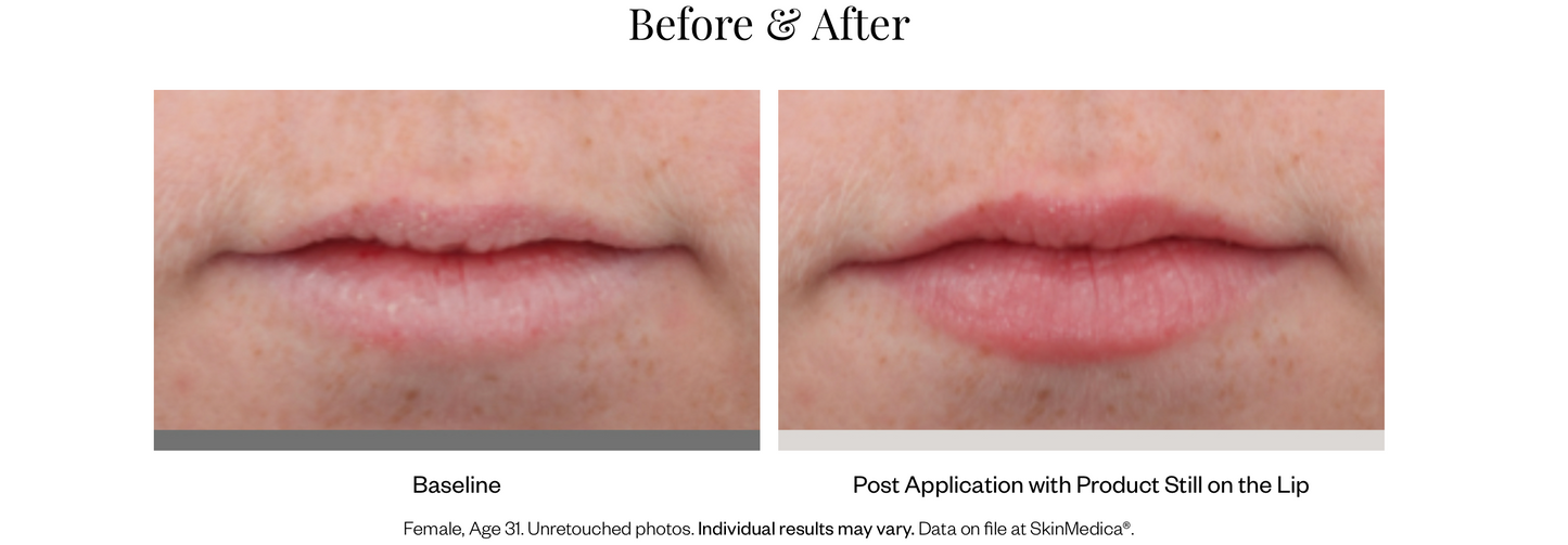 HA⁵® Smooth and Plump Lip System