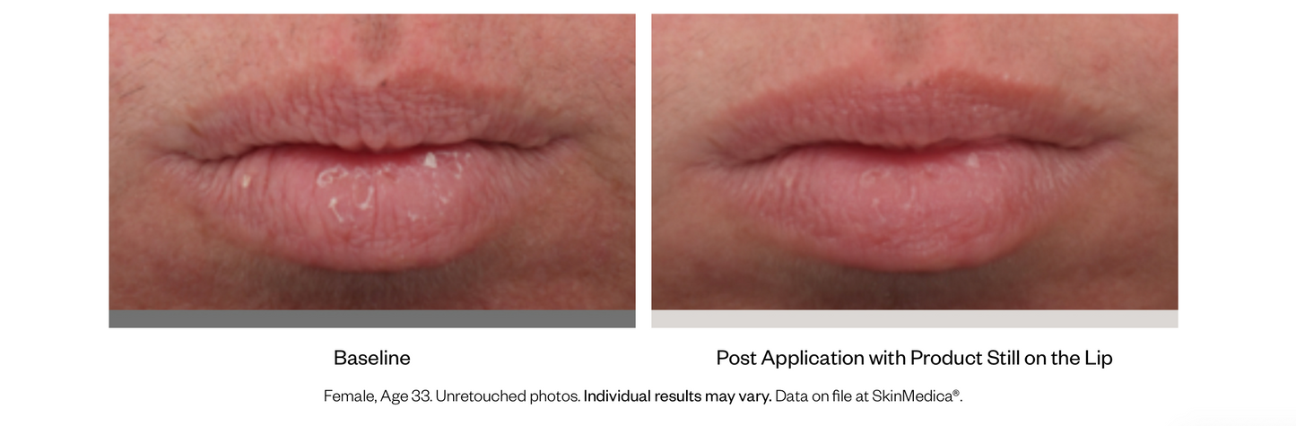 HA⁵® Smooth and Plump Lip System