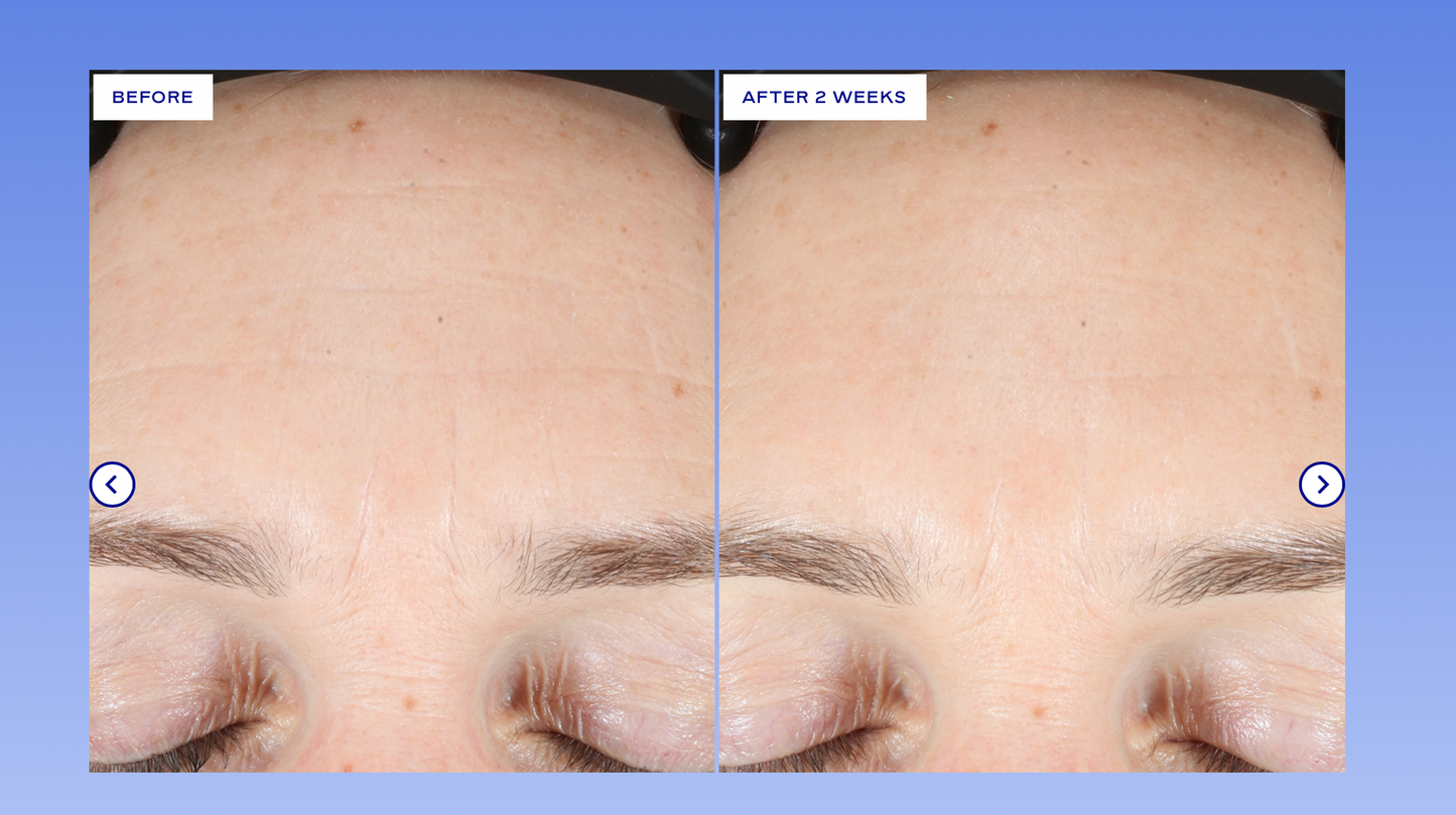 Extra Strength Active Peel Brightening System