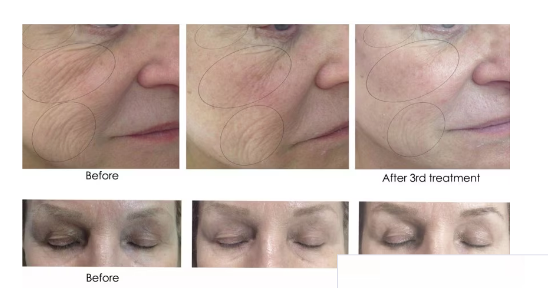CO2Lift Pro Carboxy Gel Treatment