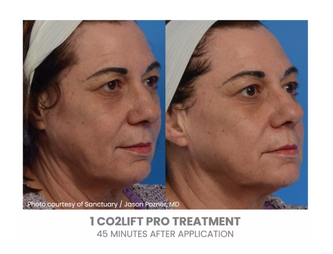 CO2Lift Pro Carboxy Gel Treatment