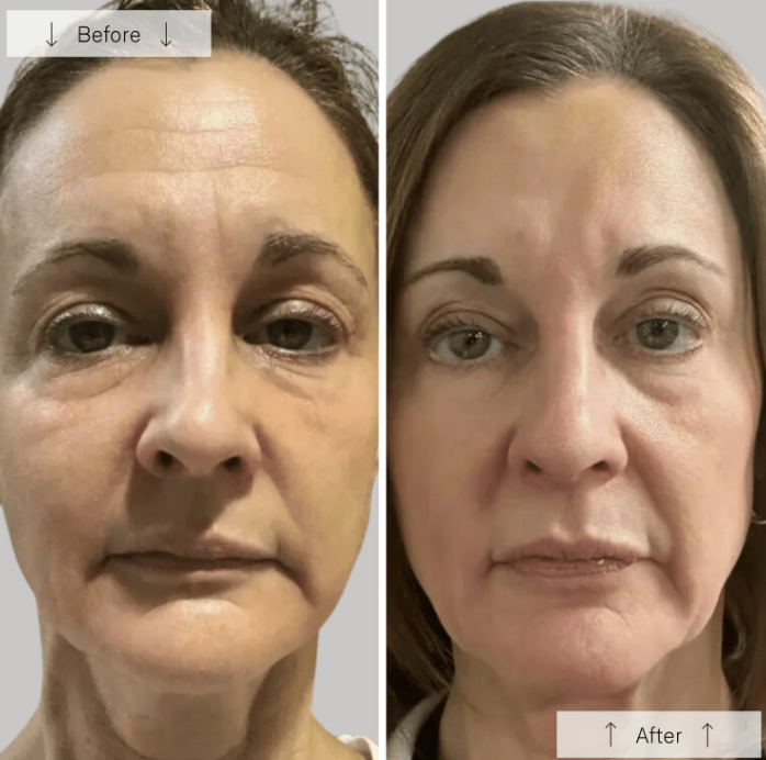 Omnilux Contour Face