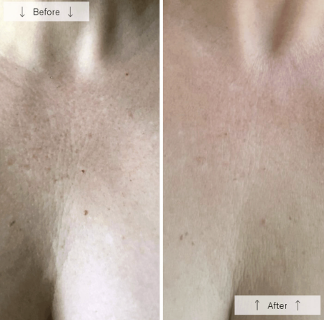 Omnilux Contour Neck & Décolleté