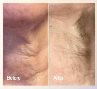 Omnilux Contour Neck & Décolleté