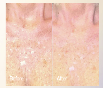 Omnilux Contour Neck & Décolleté